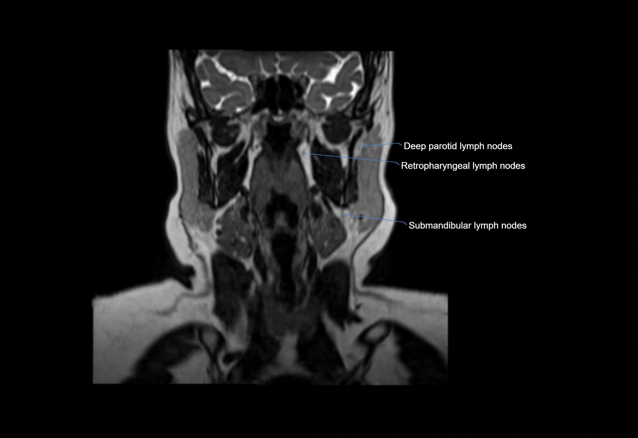 Neck coronal lymph node cross sectional MRI anatomy 3T MRI  image-img-00001-00045.webp